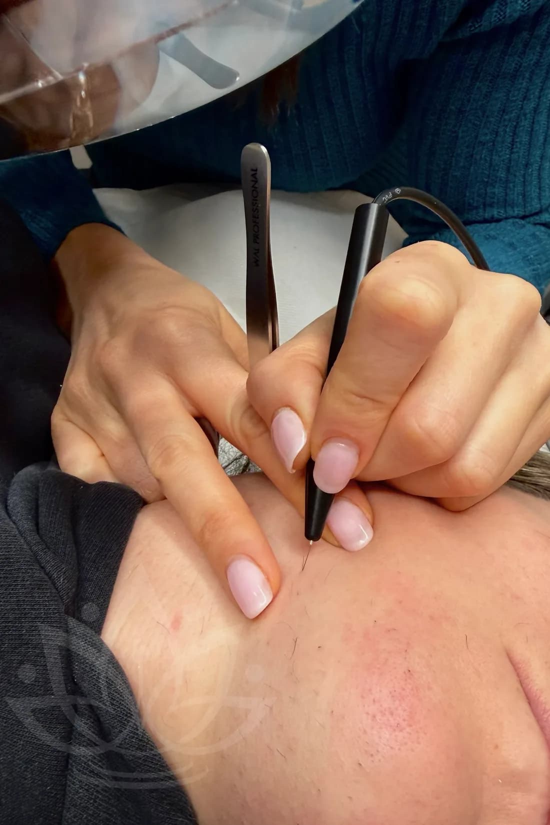 Epilazione definitiva viso