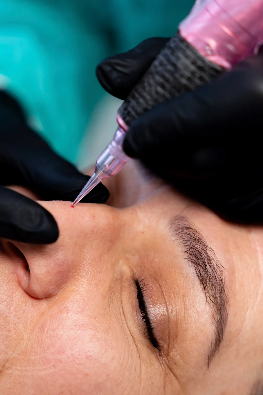 Trattamento needling con dermografo